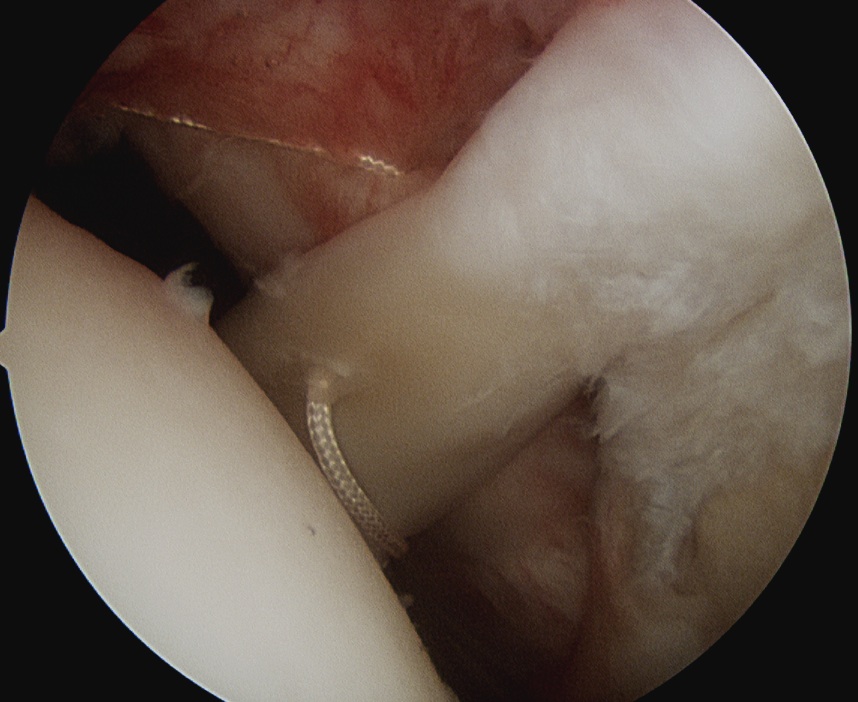 Biceps Tenodesis First Suture